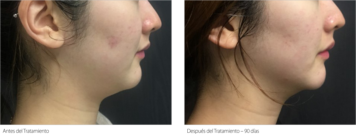 Resultado antes y después de Liftera 3
