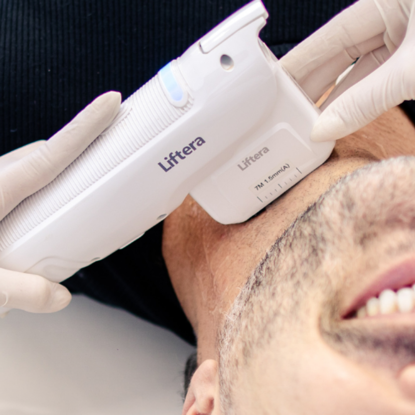 Rejuvenecimiento facial con Liftera
