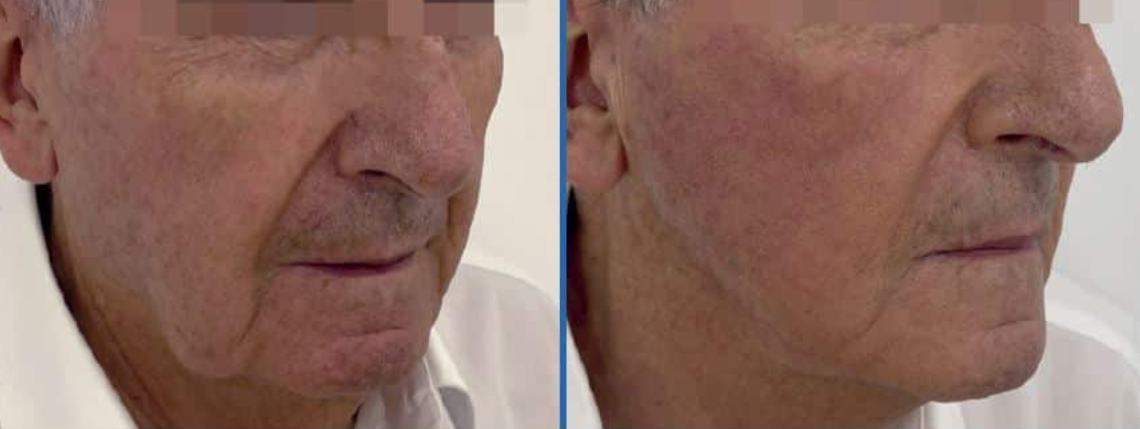 Resultado antes y después de Liftera 2