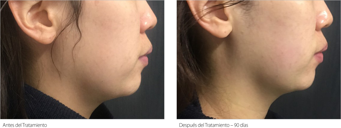Resultado antes y después de Liftera 1