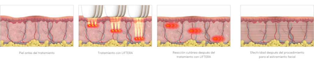 Capas de la piel tratadas por Liftera